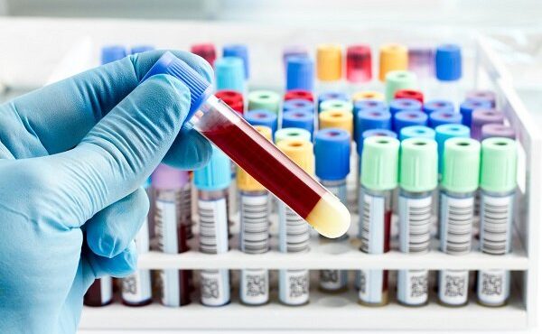 تشخیص سرطان پروستات با آزمایش جدید خون و ادرار