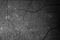 هوش مصنوعی بیماری چشمی را پیش بینی می کند