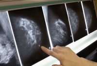 پیش بینی دقیق سرطان سینه با هوش مصنوعی