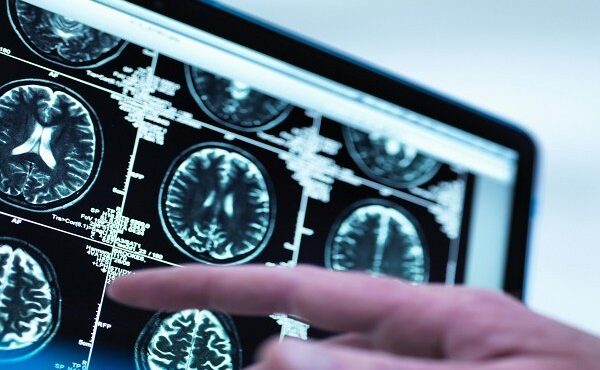 هوش مصنوعی چگونه می‌تواند به تشخیص علائم اولیه آلزایمر کمک کند