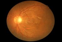 کشف نشانگرهای جدیدی که از خطر نابینایی ناشی از دیابت خبر می‌دهند
